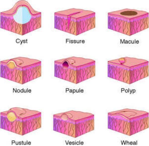 Dermatology Macule Papule Patch